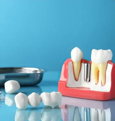 Models of a crown and an implant arranged on a blue surface