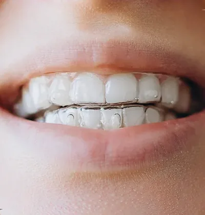 A clear aligner tray fitted over the upper front teeth